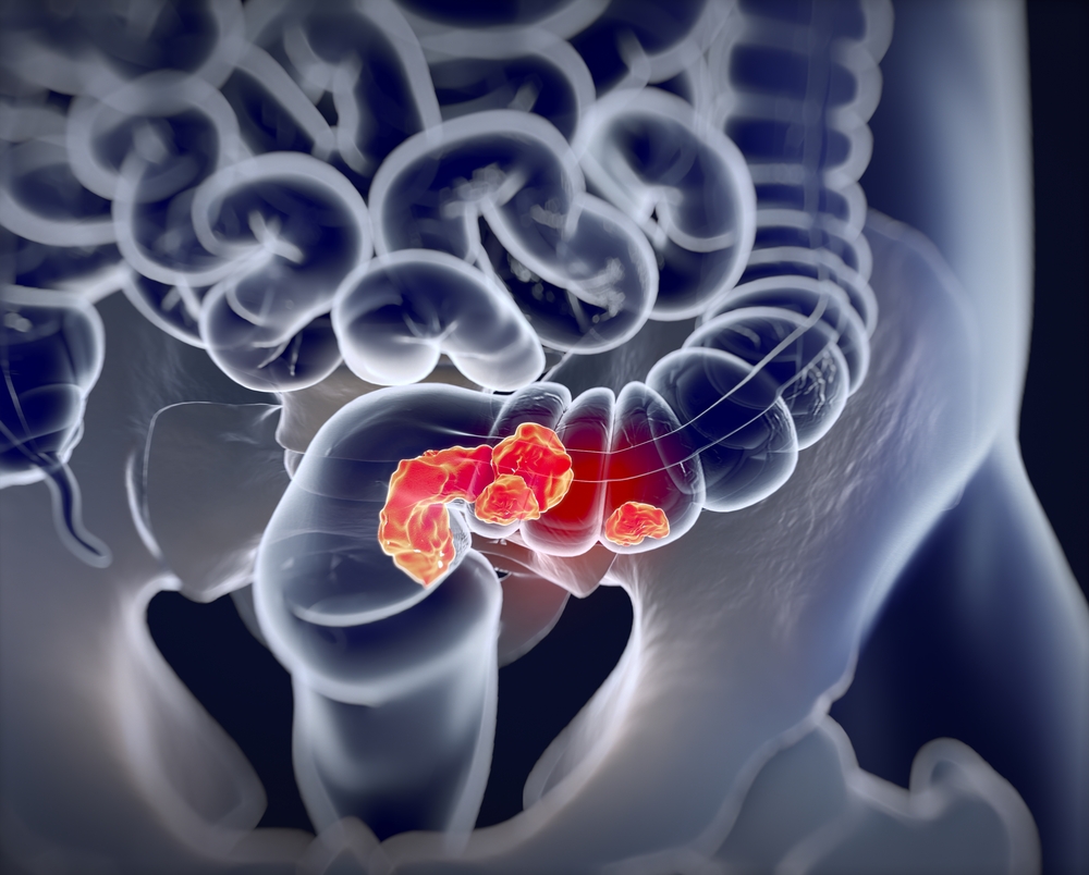 Colorectal cancer