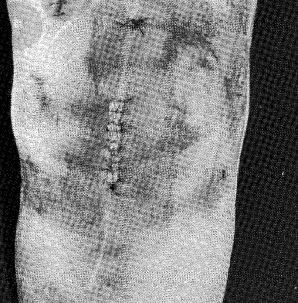 Injuries that Pamela Sue Henson allegedly suffered after a slip-and-fall outside of an open house in Middleton Injuries that Pamela Sue Henson allegedly suffered after a slip-and-fall outside of an open house in Middleton