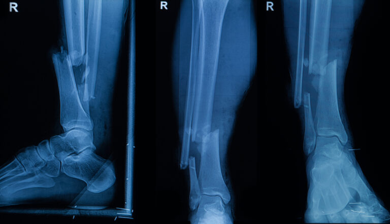Collection of human x rays showing fracture of right leg ( fracture both bones )